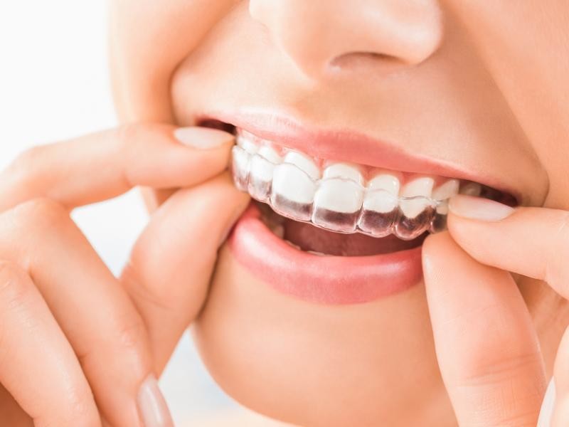 Alinhadores Invisalign