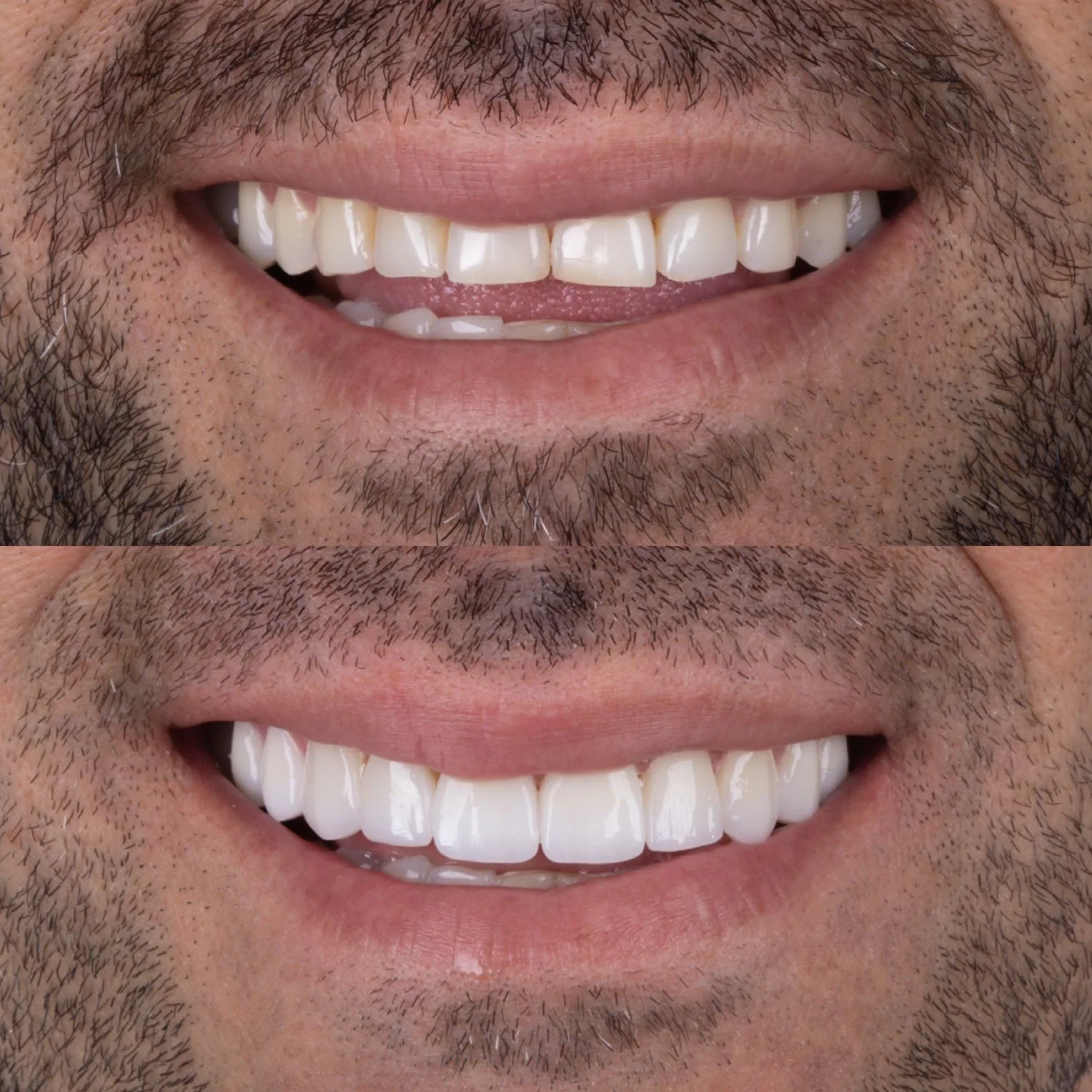 Lentes de Contato Dental